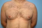 Gynecomastia Reduction