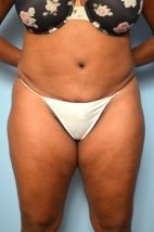 Abdominoplasty/Liposuction