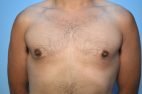 Gynecomastia reduction