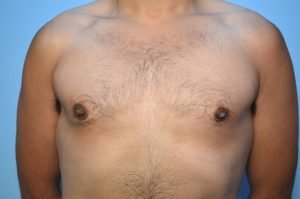 Gynecomastia reduction