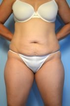 Abdominoplasty/Liposuction