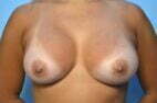 Breast Augmentation