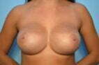 Breast Augmentation