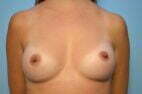 Breast Implant Removal