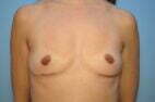 Breast Implant Removal