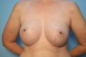 Breast Augmentation