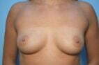 Breast Augmentation