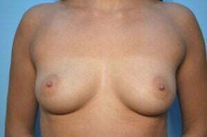 Breast Augmentation