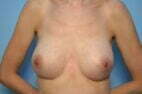 Breast Augmentation