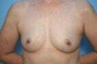 Breast Augmentation