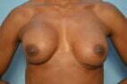 Breast Implant Removal