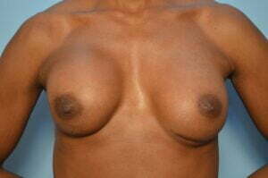 Breast Implant Removal