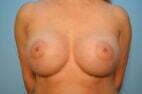 Breast Aumentation