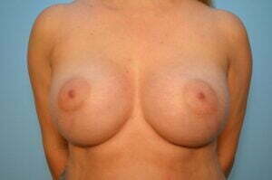 Breast Aumentation