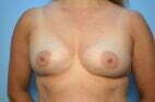 Breast Aumentation