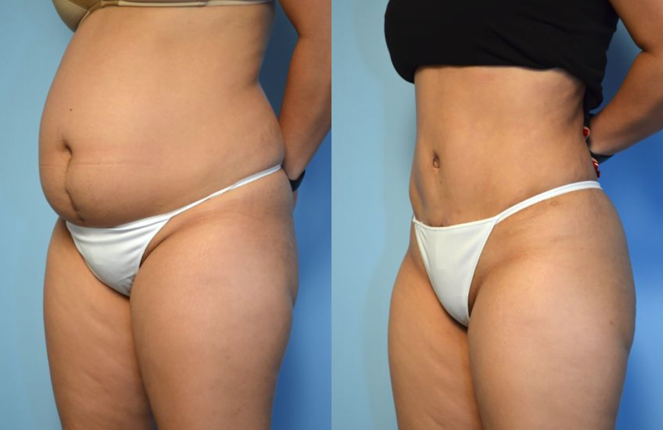 Lipoabdominoplasty