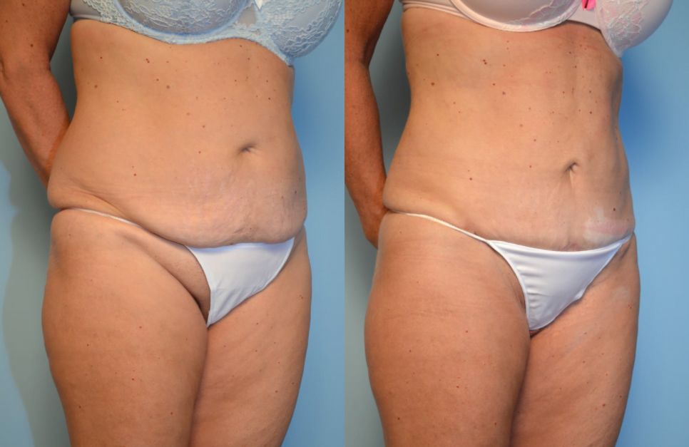 Mini Tummy Tuck