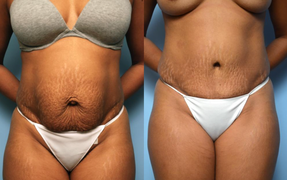 Which Type of Tummy Tuck is Right for You? - Dr. Hess