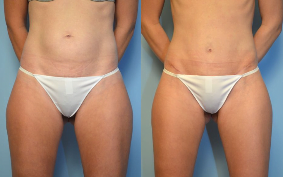 Umbilical Float Tummy Tuck