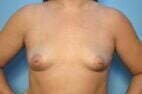 Breast Augmentation