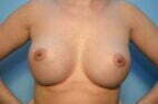 Breast Augmentation