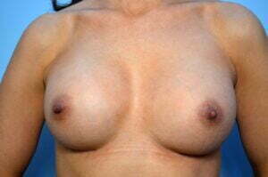 Breast Augmentation