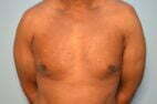 Gynecomastia