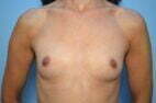 Breast Augmentation