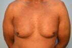 Gynecomastia