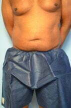 Liposuction, Mini TT