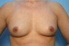 Breast Augmentation