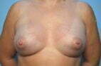 Breast Augmentation