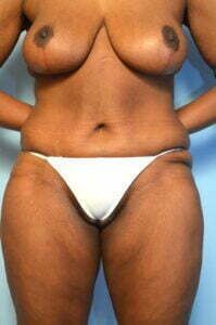 Abdominoplasty Breast Lift