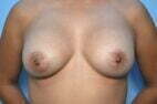 Breast implant removal