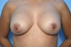 Breast implant removal