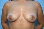 Breast implant removal