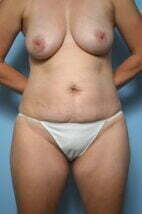 Abdominoplasty, lipo, lipo