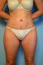 Abdominoplasty, lipo, lipo