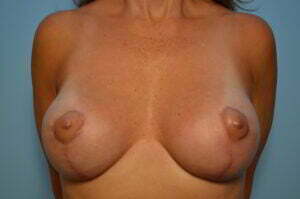 Breast Aug, lift and excision of accessory breast tissue