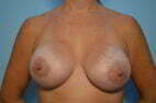 Breast Augmentation