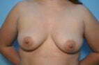 Breast Augmention
