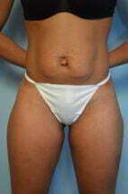 Umbilical Float Tummy Tuck