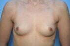 Breast Augmentation