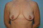 Breast Augmentation