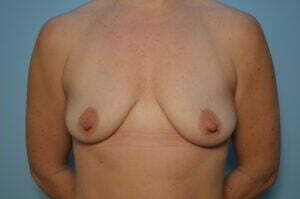 Breast Augmentation