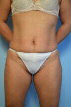 Standard Abdominoplasty