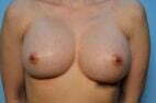 Breast Augmentation