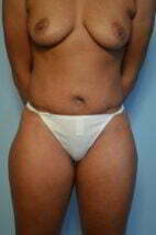 Umbilical Float Tummy Tuck