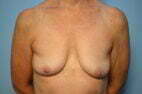 Breast Implant Removal and Total Capsulectomies