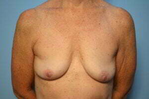 Breast Implant Removal and Total Capsulectomies
